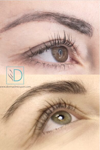 Eyebrow Transplant — Before & After