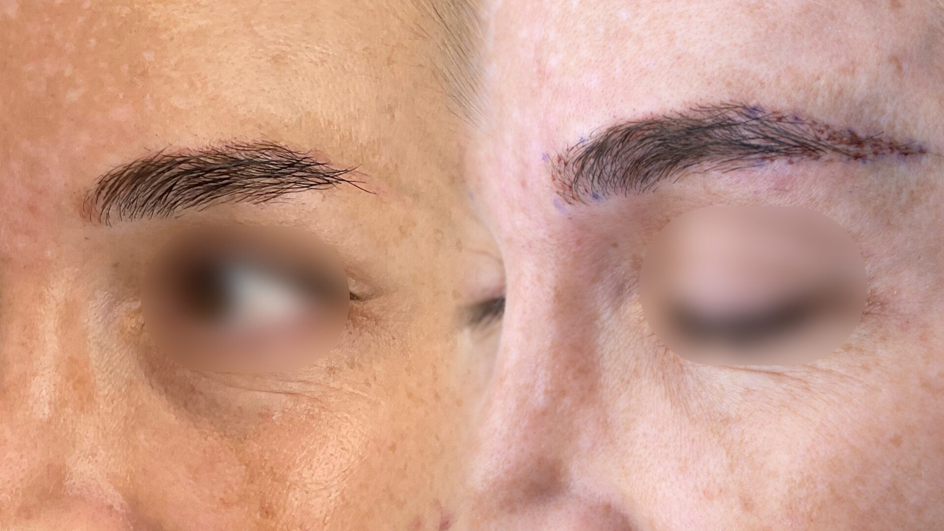 Eyebrow transplant result