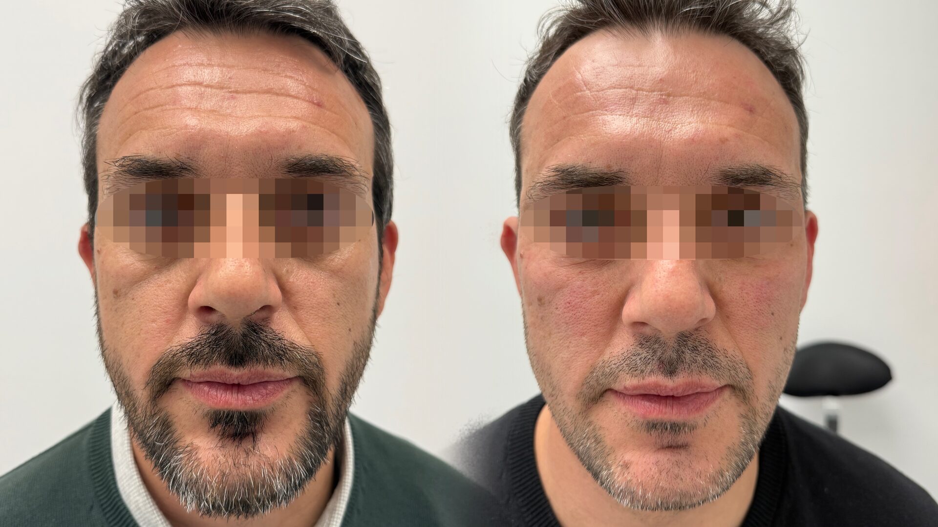 Gold Collagen before/after