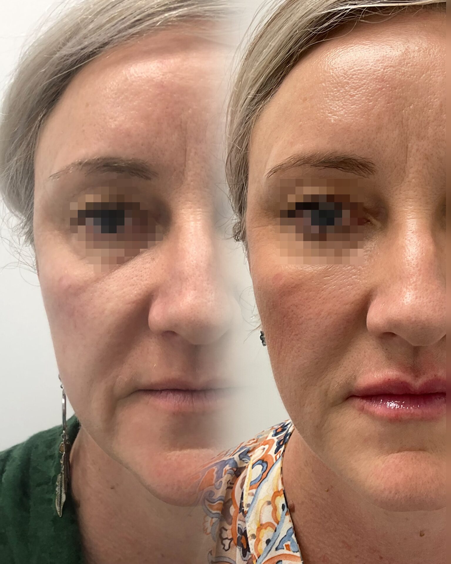 Gold Collagen before/after 3