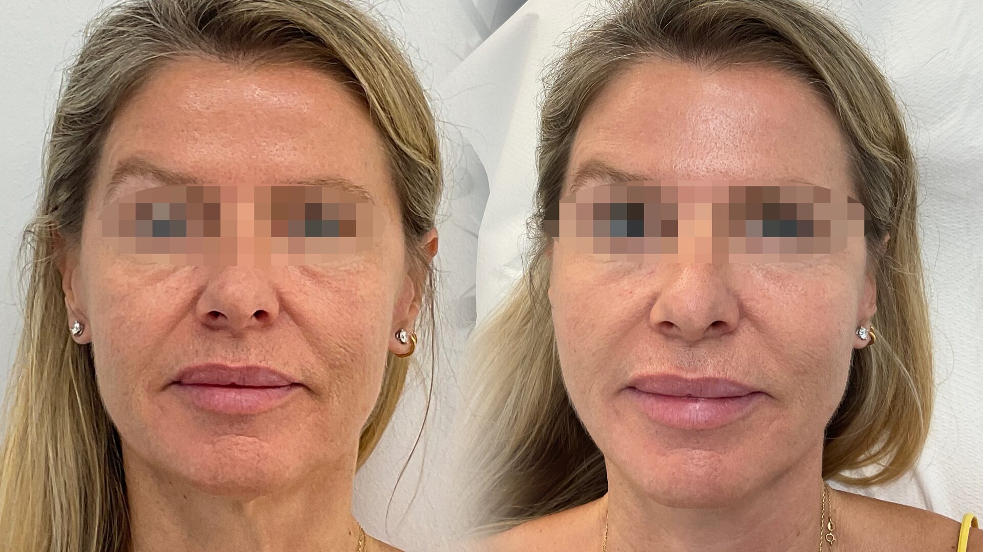 Gold Collagen before/after 4