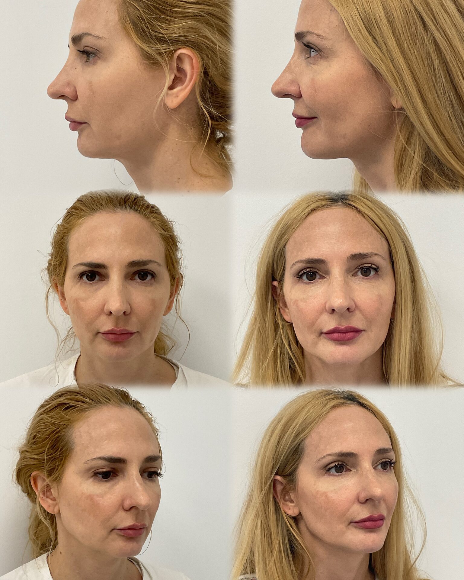 Gold Collagen Protocol — Results