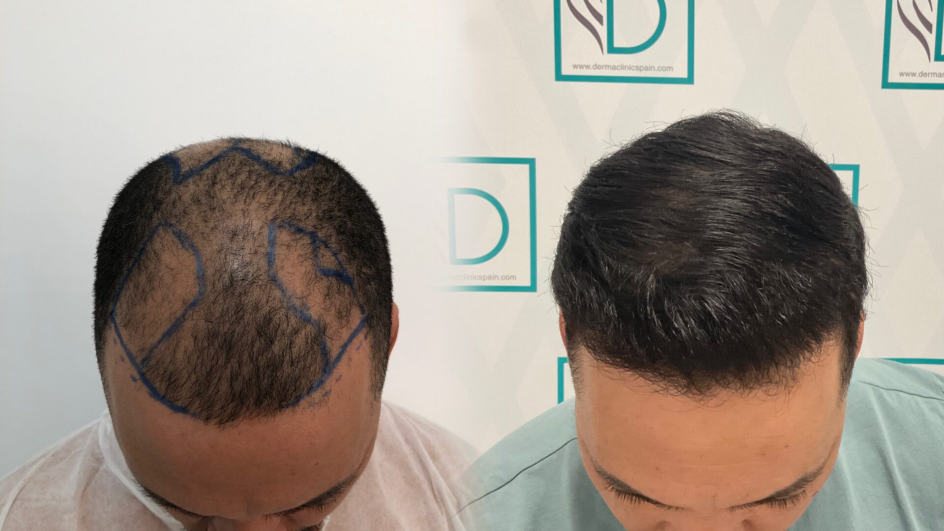 Hair transplant before/after