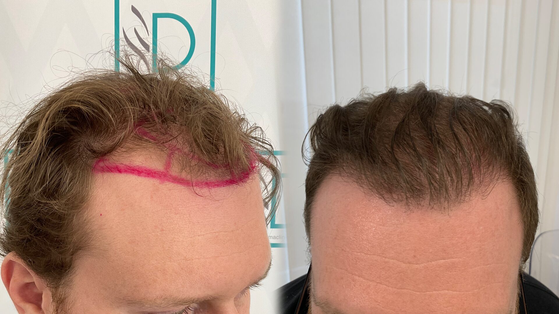 Hair transplant before/after 2