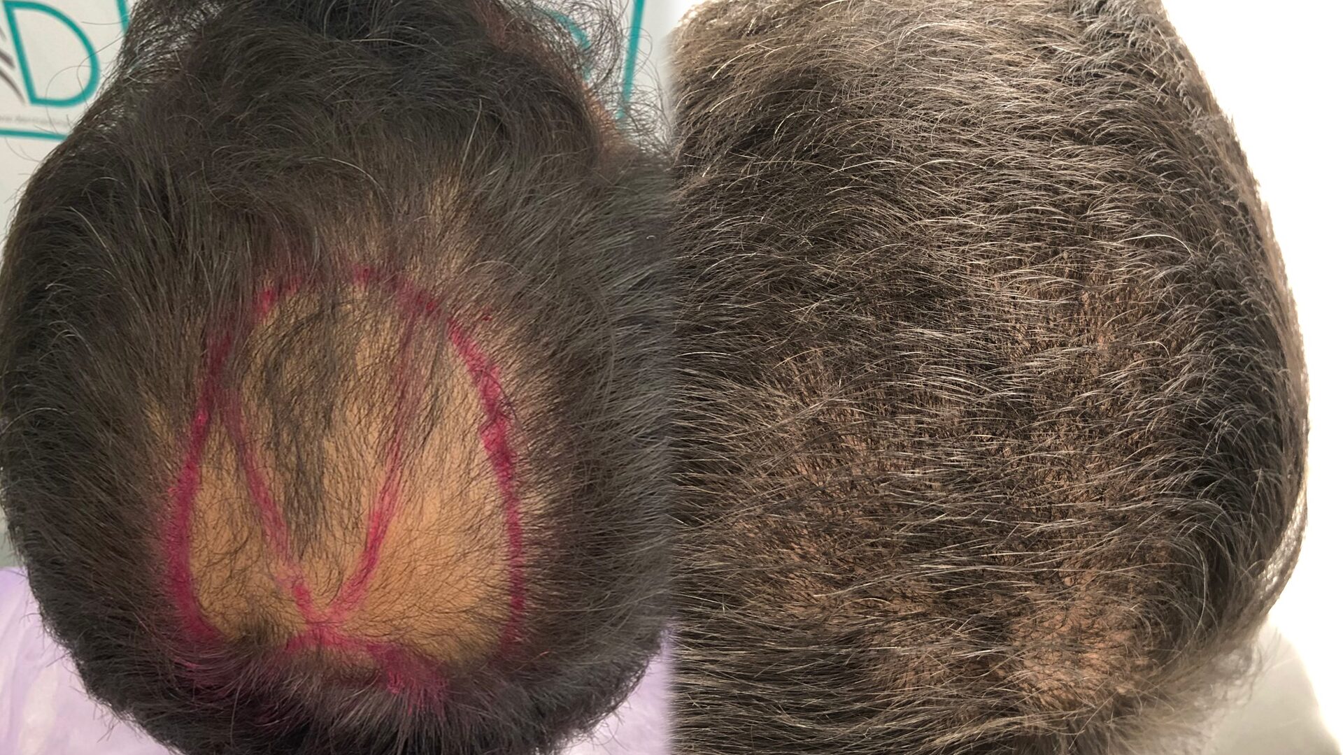 Hair Transplant FUE — Before & After