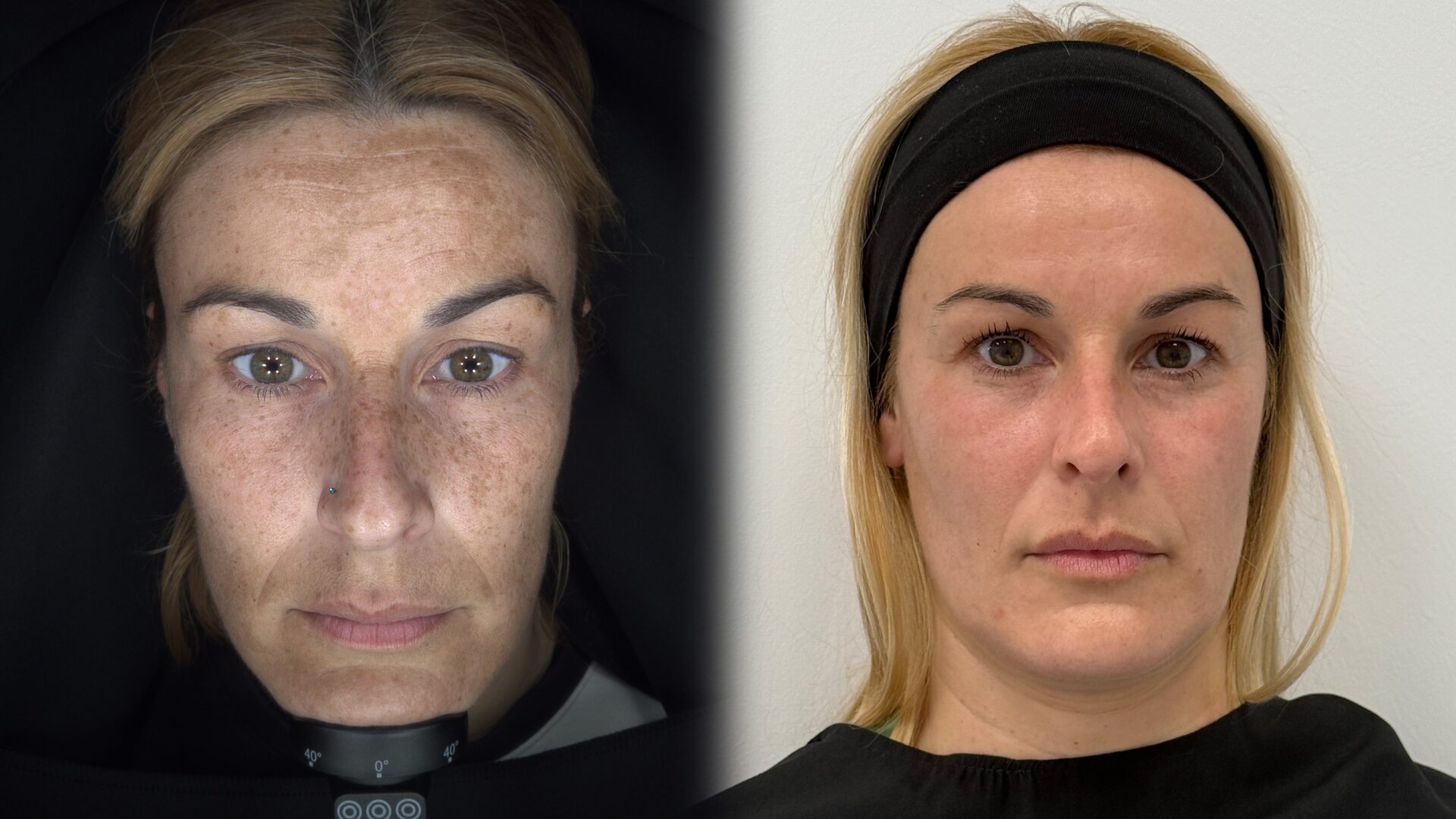 Skin Longevity before/after