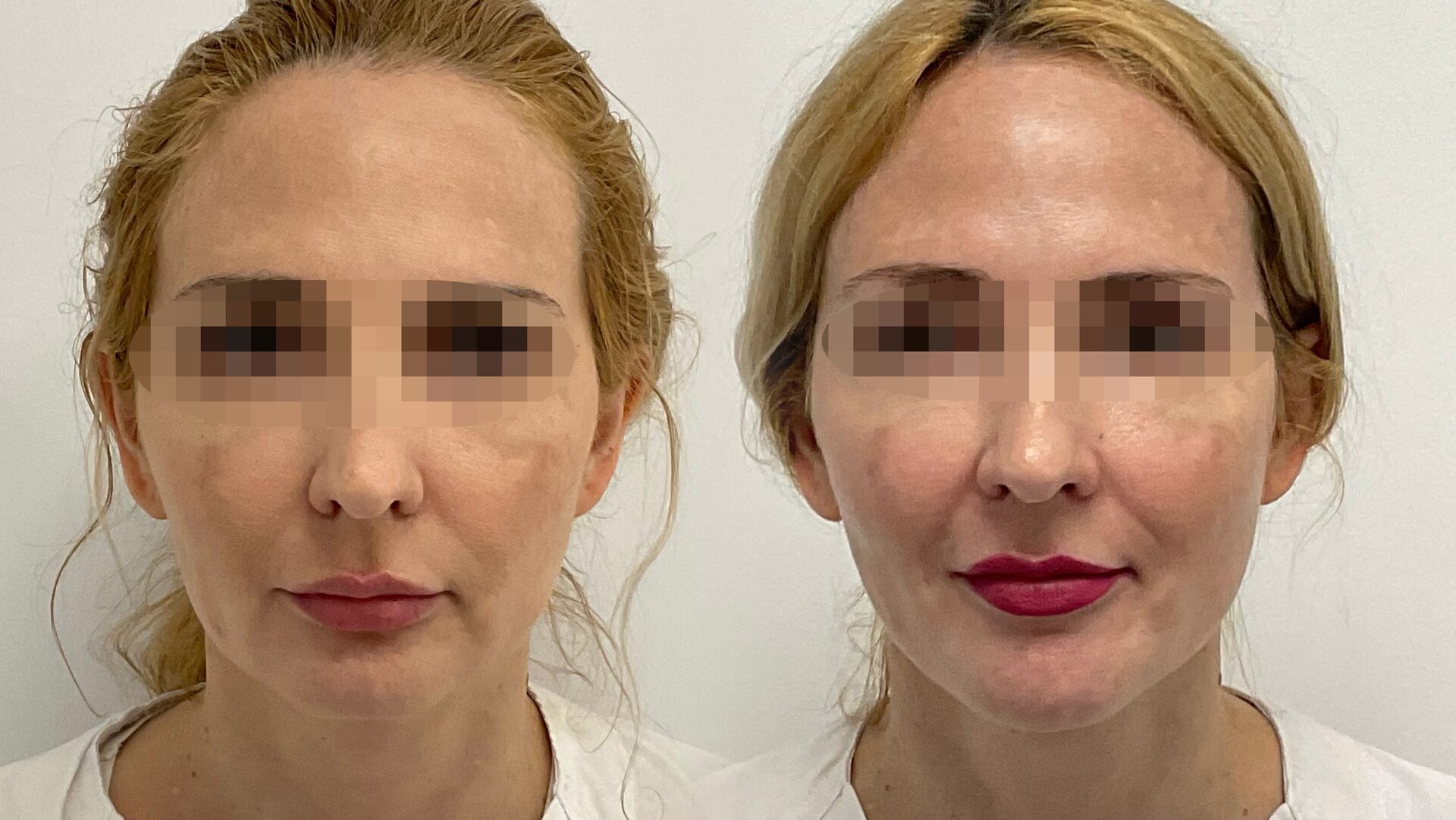 Skin Longevity before/after 3