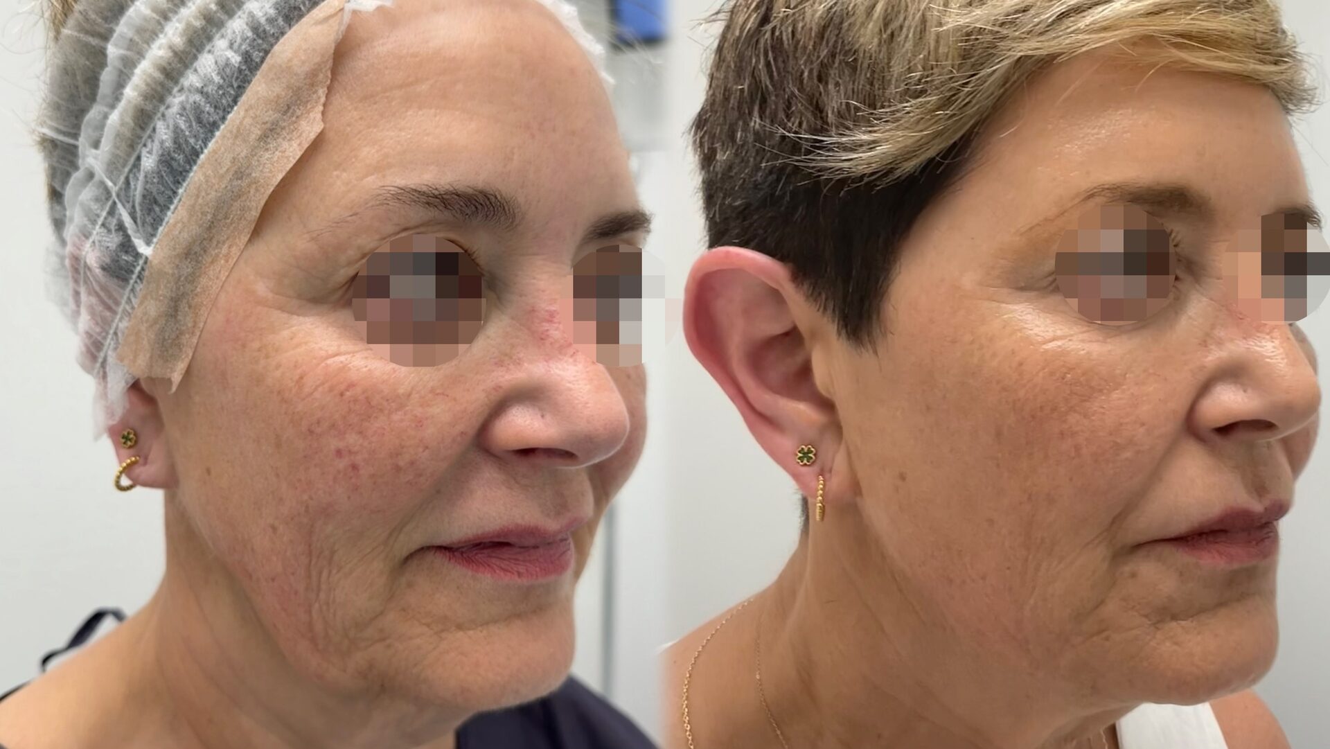 Skin Longevity before/after 4